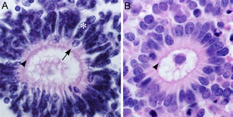 Comparison Of Dysplastic Rosettes To The Neoplastic Rosette Of