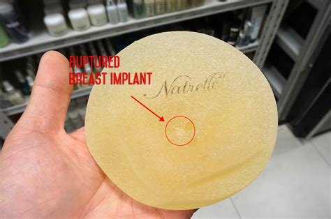 see what happens when a breast implant ruptures dr siew