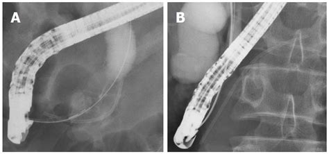 Pancreatic Stents For The Prevention Of Post Endoscopic Retrograde Cholangiopancreatography