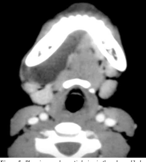 Figure 5 From Imaging Of Cystic Neck Masses In Adults Semantic Scholar