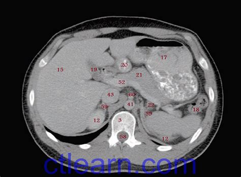 Learn Ct Scan Anatomy Ct Axial Abdomen And Pelvis Male