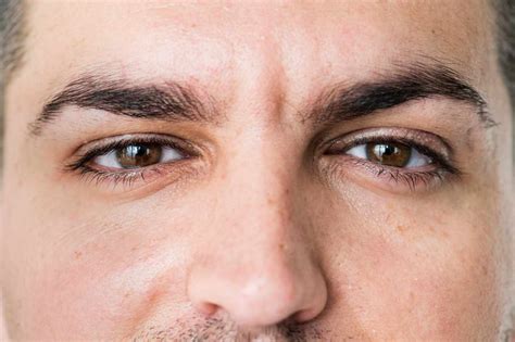 Wytrzeszcz Oczu Przyczyny Objawy I Leczenie Medycyna Pl