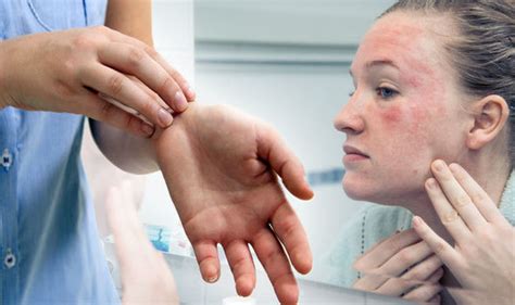 Eczema Treatment Three Nhs Recommendedways To Soothe