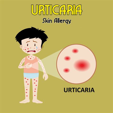 Itchy Bumps On Skin Urticaria Or Hives In Children Dr Ankit Parakh