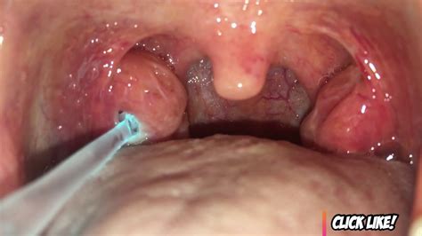 Tonsil Stones Tonsilloliths Symptoms Causes Treatment Prevention