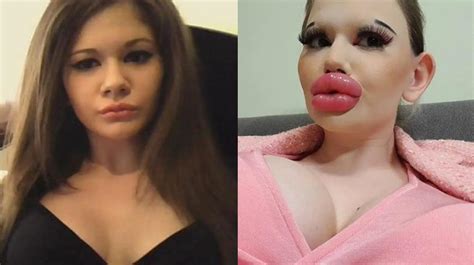 La mujer de los labios más grandes del mundo con 33 inyecciones de
