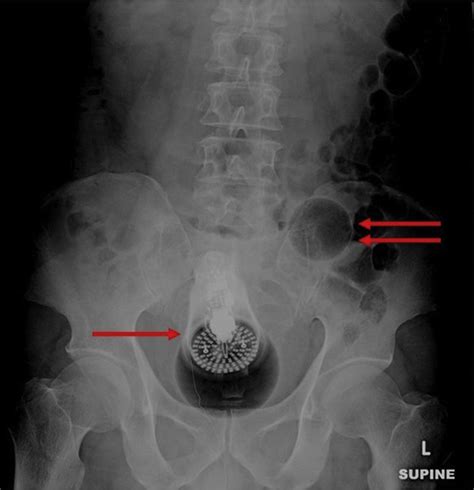 Rectal Injury After Foreign Body Insertion Secondary Analysis From The Aast Contemporary