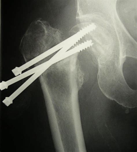 Right Hip With Screw Backout And Loss Of Fracture Fixation Download