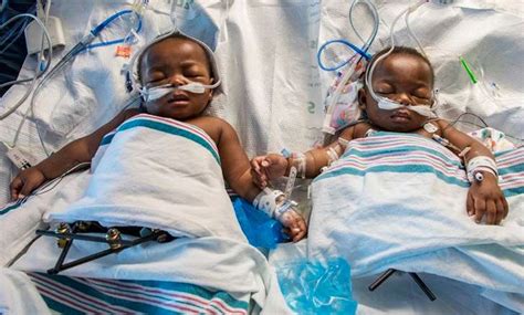 Conjoined twins separated after 18-hour surgery - News ...