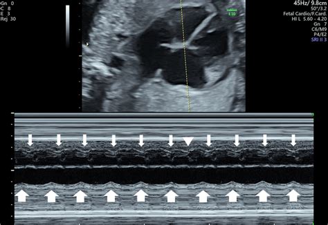 Fetal M Mode Ultrasound Ventriculo Atrial Dissociation In Atypical