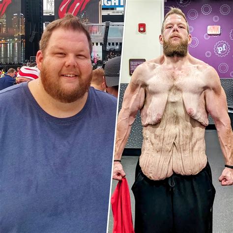 He Started Walking And Lost 360 Pounds But Loose Skin Makes Him Feel Trapped