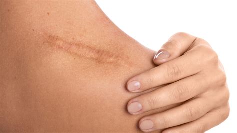 How To Relieve Pain From Scar Tissue Using Rapid