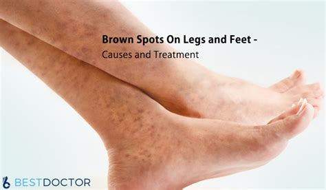 Brown Spots On Legs And Feet Causes And Treatment