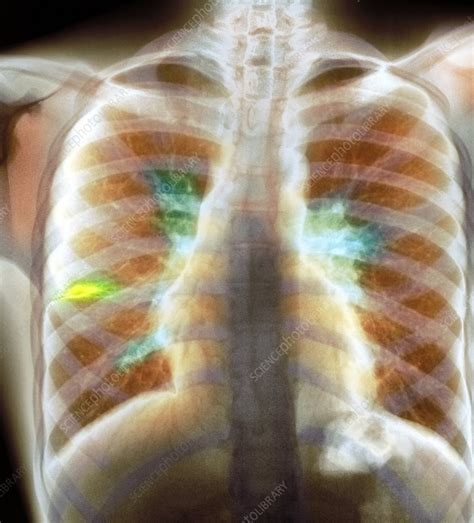 Tuberculosis Lymphadenopathy X Ray Stock Image C0072677 Science