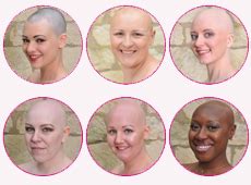 Gail Porter Admits Alopecia Caused Loneliness