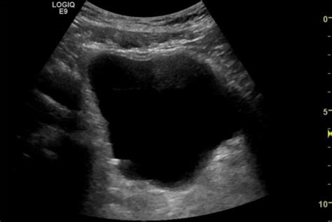 Bladder Stone Case 1 • Litfl • Ultrasound Clinical Cases