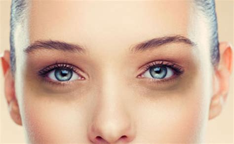 Have Dark Circles Under Your Eyes Expert Dermatologist Recommends
