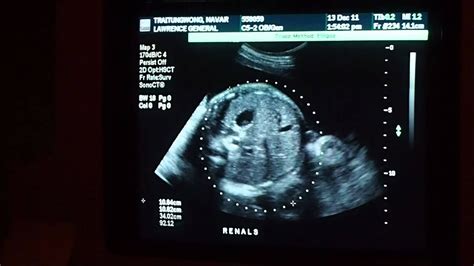 Andreas Ultrasound 36 Weeks And 4 Days Youtube