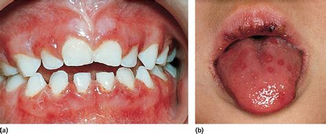 Herpes In Mouth Pictures On Tongue Bumps Underneathe Tongue Some Red