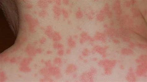 Amoxicillin Rash Pictures Medical Pictures And Images 2023 Updated