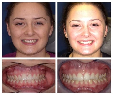 How To Fix A Crooked Smile Naturally Crooked Teeth Causes Problems