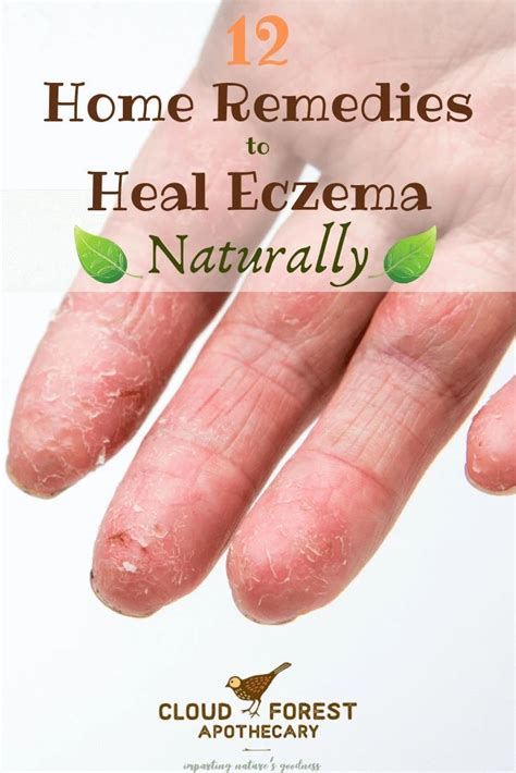 12 Home Remedies To Heal Eczema Naturally Cloud Forest Apothecary