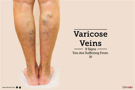 Varicose Veins 9 Signs You Are Suffering From It By Dr Himanshu