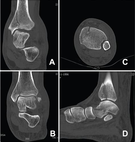 Acute Achilles Tendon Rupture Associated With Medial Malleolar Fracture