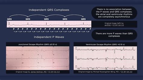 To make up for this, a section of the ventricles acts like a pacemaker to create electrical signals. Third Degree Atrioventricular Block ECG - YouTube