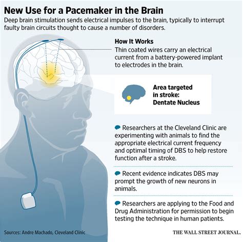 New Frontier For Deep Brain Stimulation Therapy Is Recovery From Stroke