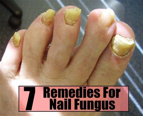 7 Effective Home Remedies For Nail Fungus Personal Care Pinterest