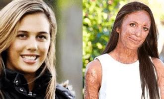 What Happened To Turia Pitt Accident Details And Before Photos How Did She Get Burnt Tg Time