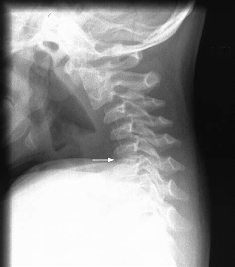 Calcified Cervical Disc In A Three Year Old Emergency Medicine Journal