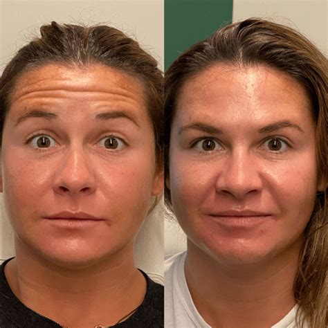 How Long Does It Take For Botox To Work Boss Gal Beauty Bar