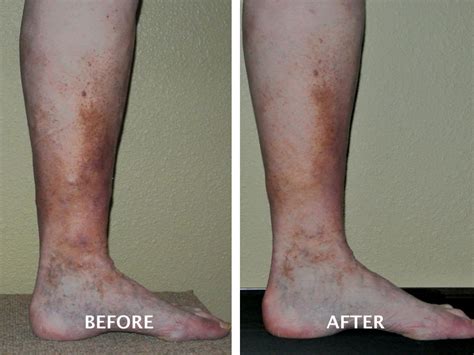 Venous Ulceration Treatment Boise Advanced Vein Therapy
