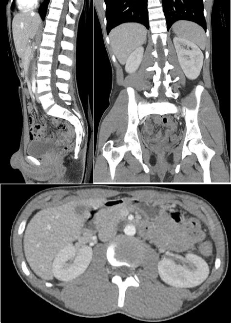 File CT Of A Normal Abdomen And Pelvis Thumbnail Png