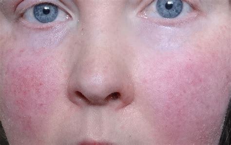 Scarlet Letters Dealing With Vascular Rosacea Face Flushing Burning