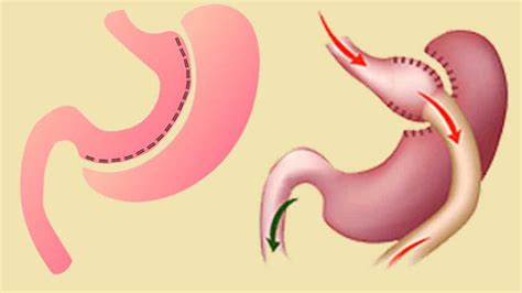 Gastric Sleeve Vs Gastric Bypass Surgery Pros And Cons