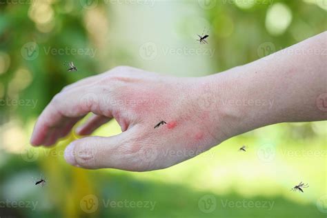 Mosquitoes Bite On Adult Hand Made Skin Rash And Allergy With Red Spot Stock Photo At