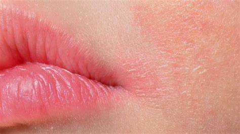 Лечение атопического дерматита диета