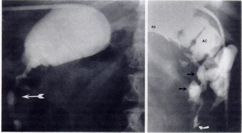 A Contrast Injection Into Intrahepatic Abscess Demonstrates Sinus