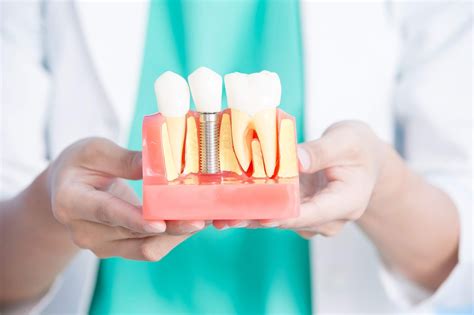 Significant Features Of Modern Dental Implants
