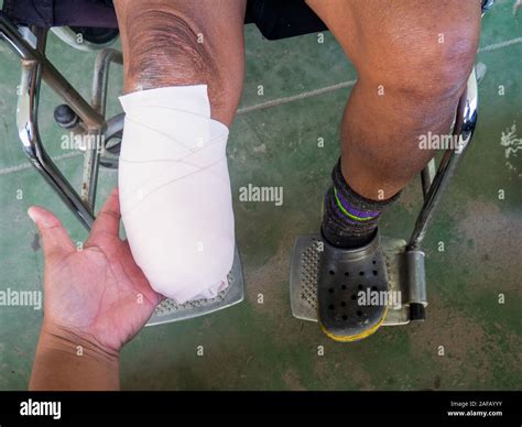 Below Knee Amputation With Elastic Bandage Stock Photo Alamy