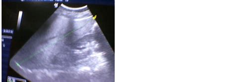 Correlation Between Abdominal Ultrasonographic Findings And Cd Cell Count In Adult Patients