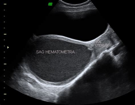 A Case Of Uterus Didelphys With Unilateral Renal Agenesis And