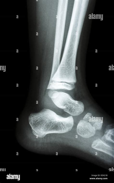 Film X Ray Normal Childs Ankle Stock Photo Alamy