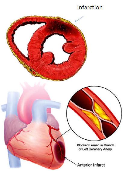 Myocardial Infarction