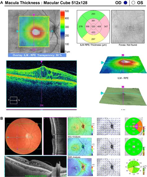 A Diabetic Macular Edema Persistent After 10 Intravitreal Bevacizumab