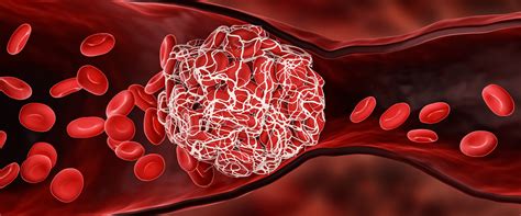 What To Know About Blood Clots And Covid 19