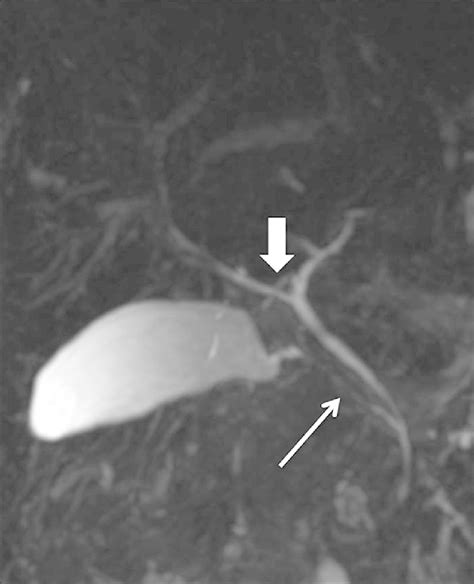Coronal Mrcp Image Showing Parallel Course Of Cystic Duct Arrow With